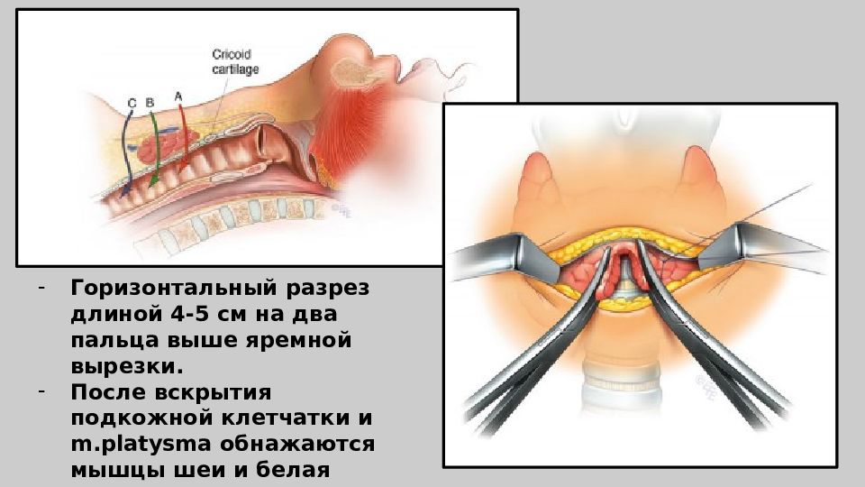 Торакальная хирургия презентация