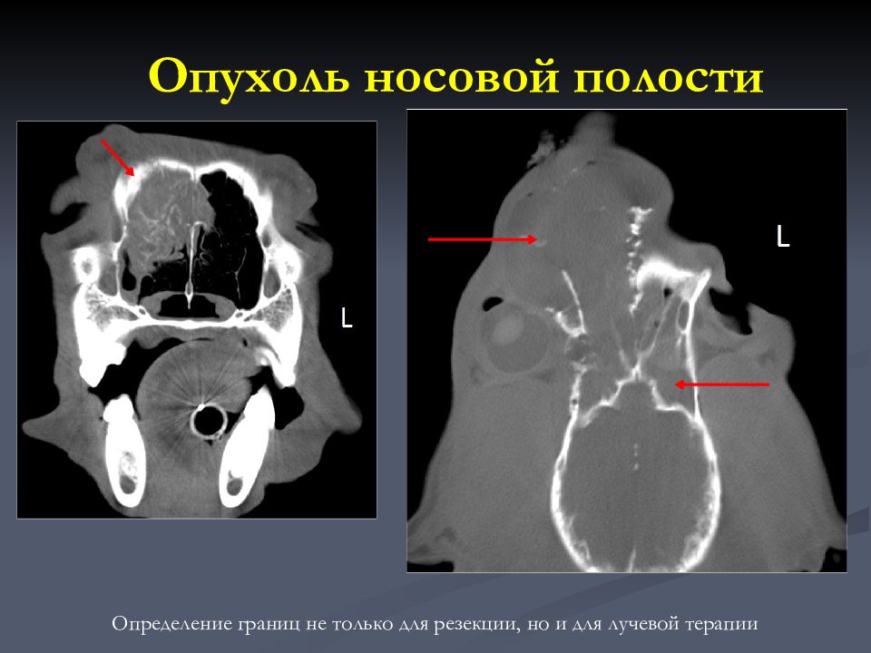 Опухоли полости носа