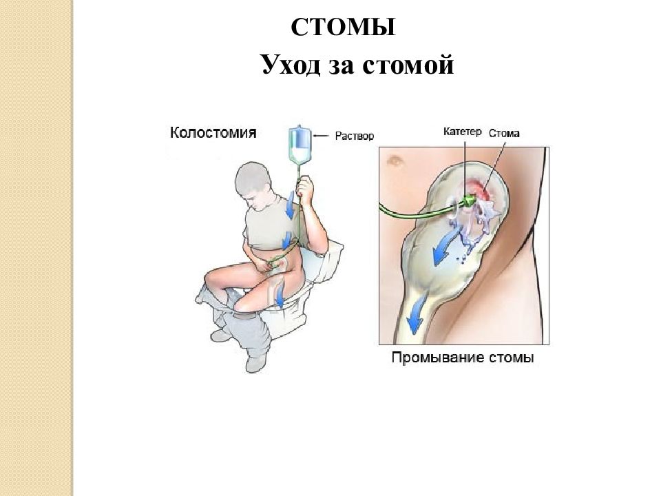 Стома виды. Презентация на тему Стома.