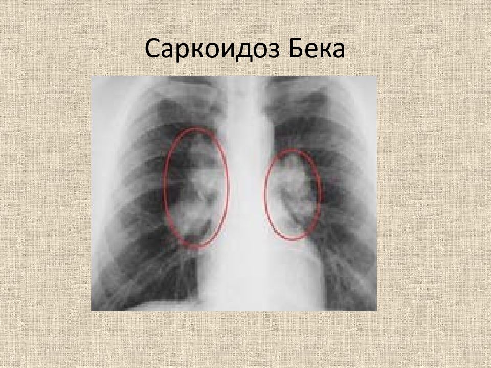 Саркоидоз легких презентация