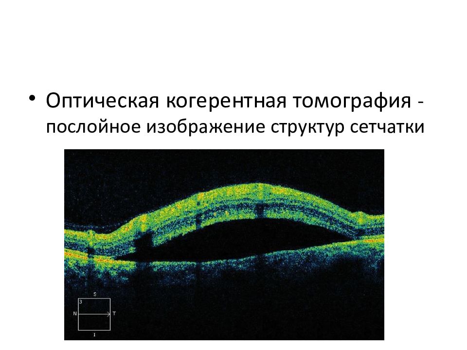 Презентация на тему отслойка сетчатки