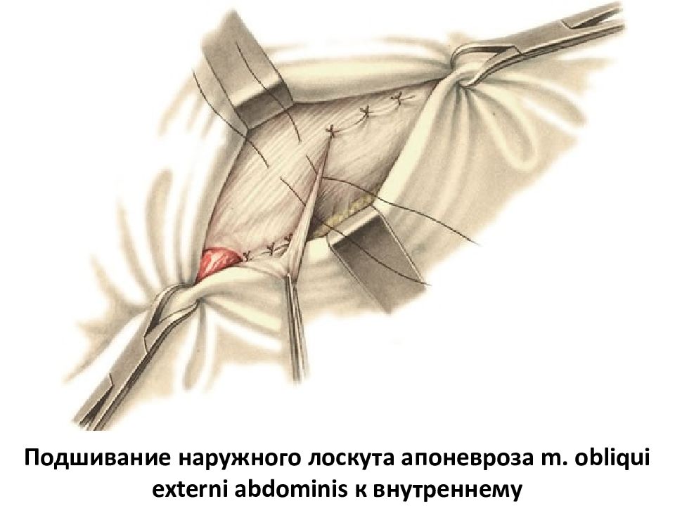 Паховая грыжа у женщин. Пластика Жирара Спасокукоцкого Кимбаровского. Руджи Парлавеччио пластика. Паховая грыжа метод Жирара. Пластика по Жирару Спасокукоцкому со швами Кимбаровского.