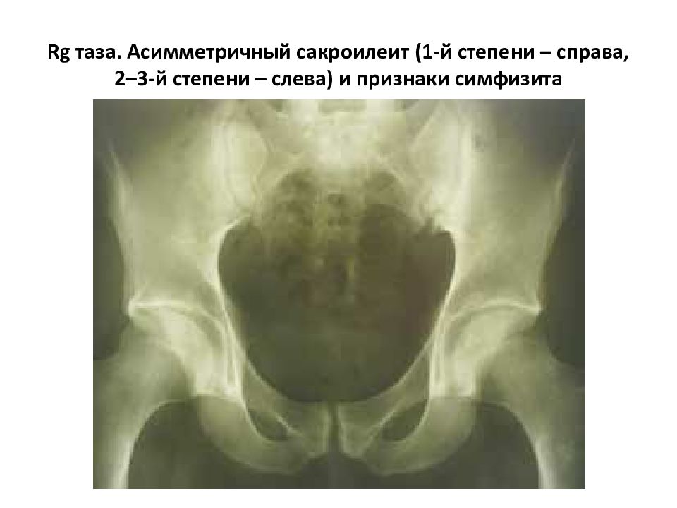 Симфизит. Рентген таза на сакроилеит. Рентген костей таза сакроилеит. Туберкулезный сакроилеит. Симфизит на рентгенограмме.