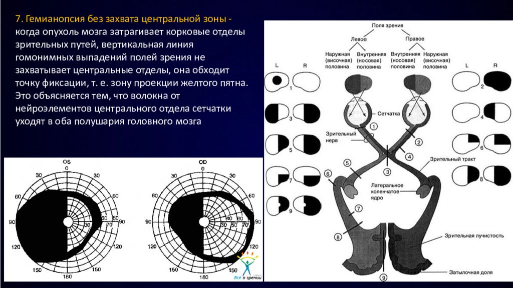 Центральные изменения. Гетеронимная гемианопсия. Поля зрения гемианопсия. Поражение зрительного нерва гемианопсия. Левосторонняя гемианопсия поля зрения.