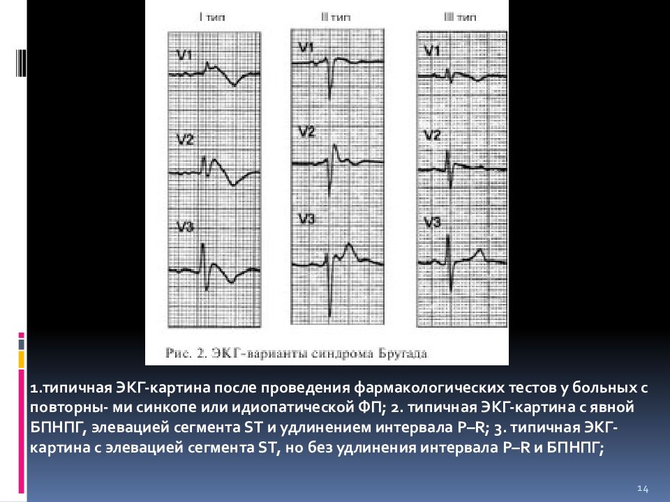 Реполяризация нижней стенки. Атропиновая проба ЭКГ. Удлинение интервала PQ на ЭКГ. Элевация сегмента St при Бругада. CLC синдром ЭКГ признаки.