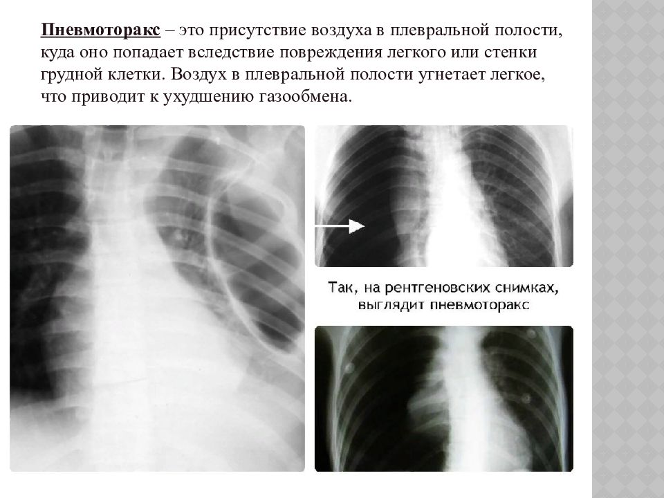 Спонтанный пневмоторакс презентация