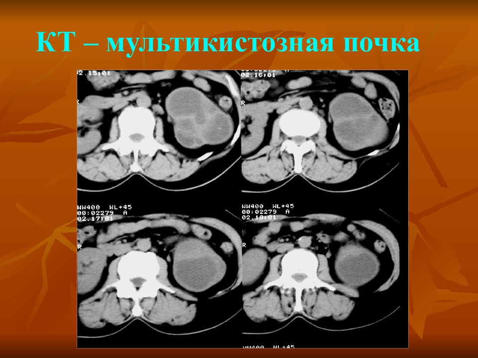 Кт почек презентация