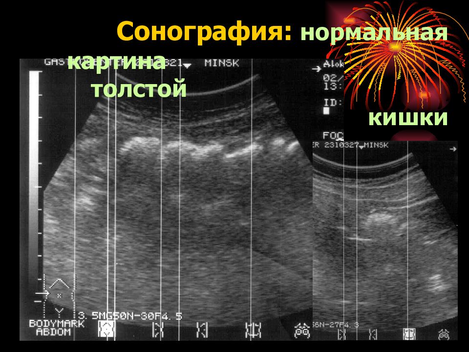 Узи кишечника. Воспаление кишечника на УЗИ. Нормальные кишечник на УЗИ. УЗИ кишечника воспалительные заболевания.