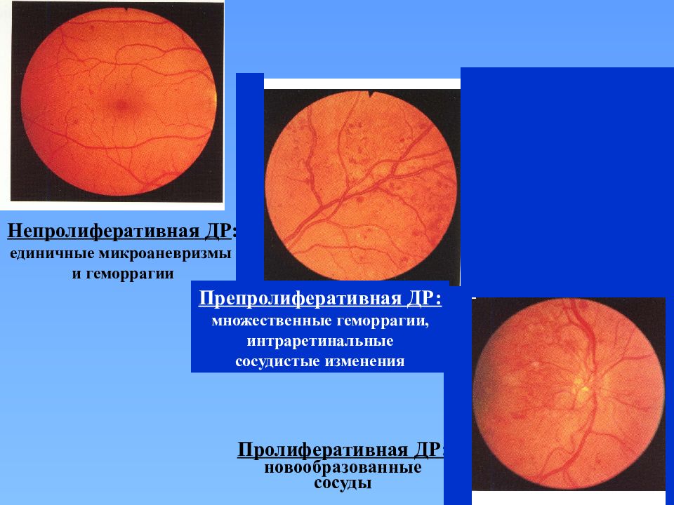Сосудистые изменения. Интраретинальные геморрагии. Микроаневризмы сетчатки. Единичные микроаневризмы.