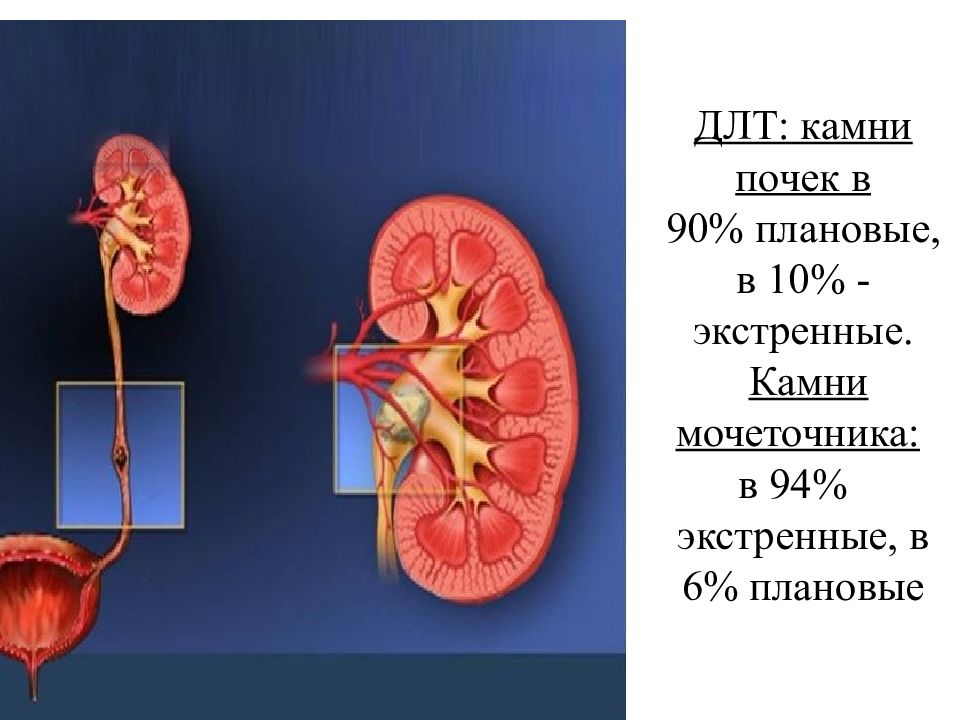 Камень в мочеточнике. Дистанционная литотрипсия при камнях почек. ДЛТ камней в почках. Камни из почек в мочеточнике.