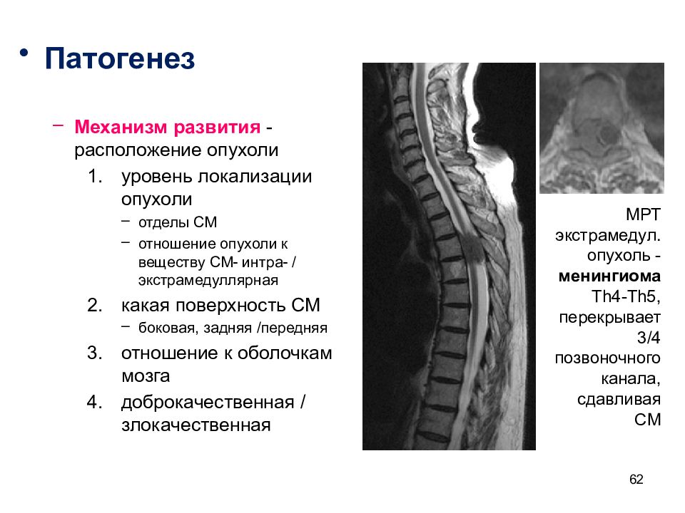 Опухоли цнс презентация