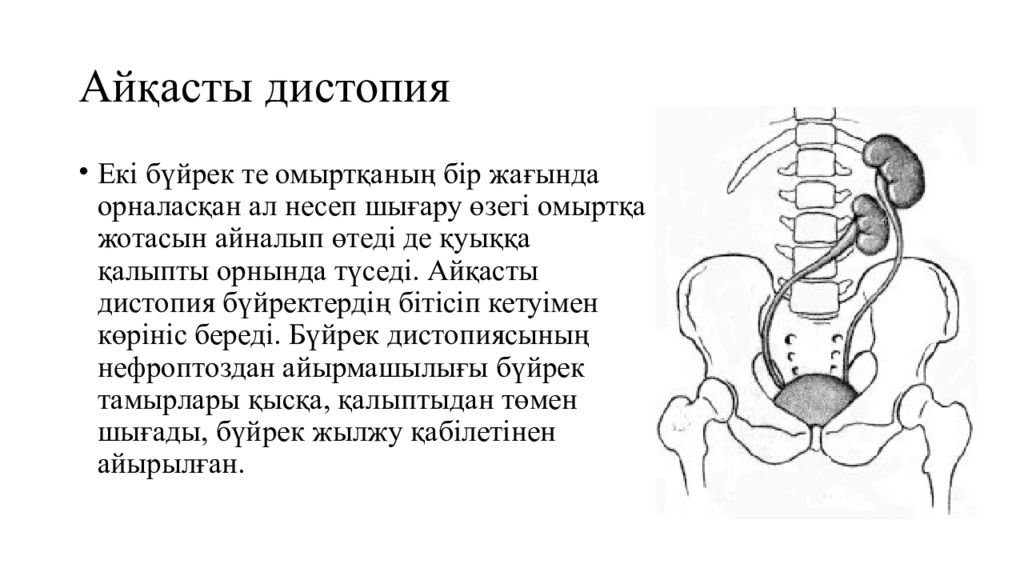 Нефроптоз дистопия. Гомолатеральная дистопия почки. Подвздошная дистопия правой почки. Варианты положения почек.