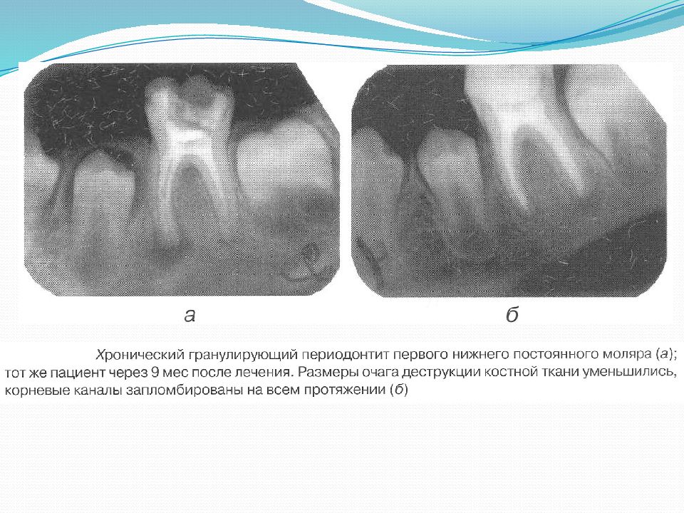 Хронический фиброзный периодонтит лечение. Апикальный периодонтит рентген. Гранулематозный периодонтит гистология. Фиброзный периодонтит рентген. Хронический апикальный гранулирующий периодонтит.