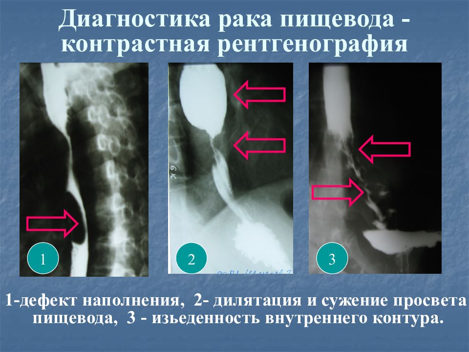 Рентгенологическая картина рака пищевода экзофитный эндофитный