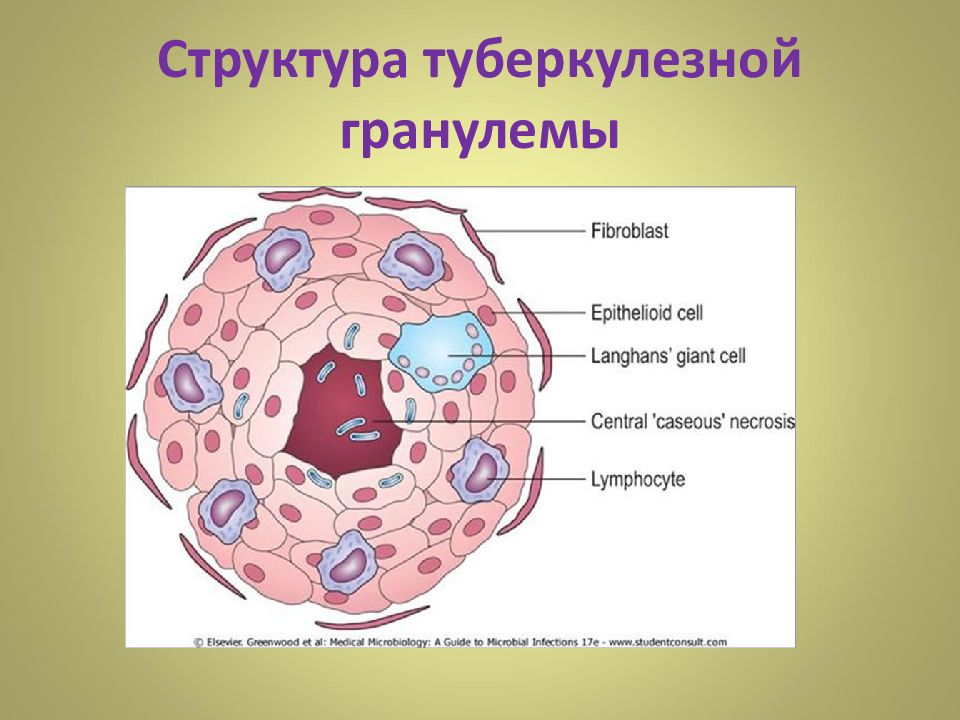 Туберкулезная гранулема рисунок