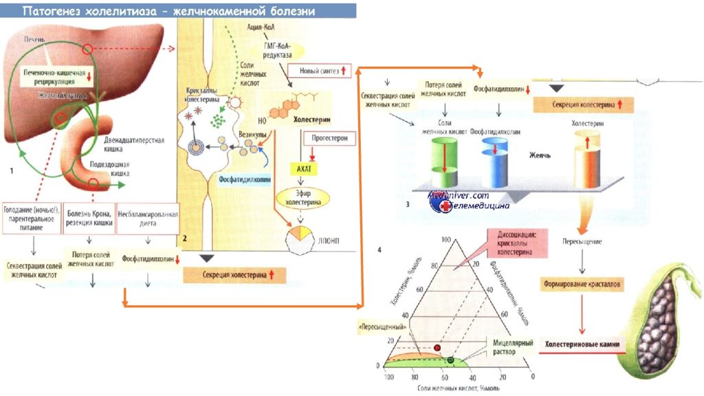 Патогенез болезни. Схема патогенеза образования желчных камней. Патогенез образования желчных камней. Желчекаменная болезнь патогенез камнеобразования. Этиология и патогенез образования желчных камней.