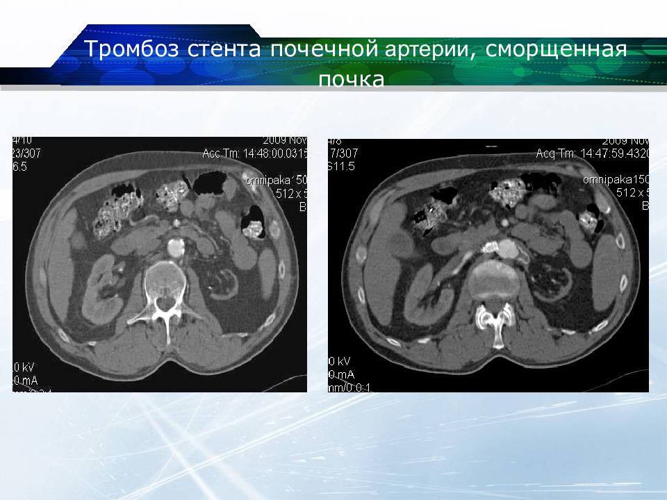 Кт почек презентация