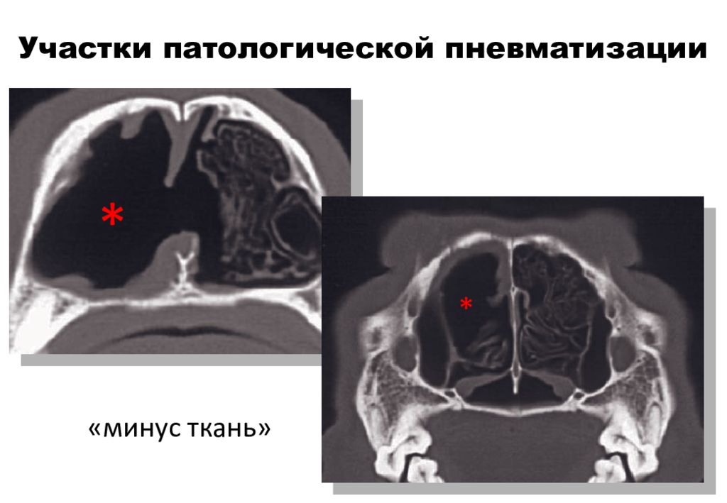 Пневматизация. Томография компьютерная лицевого черепа лицевого отдела черепа.