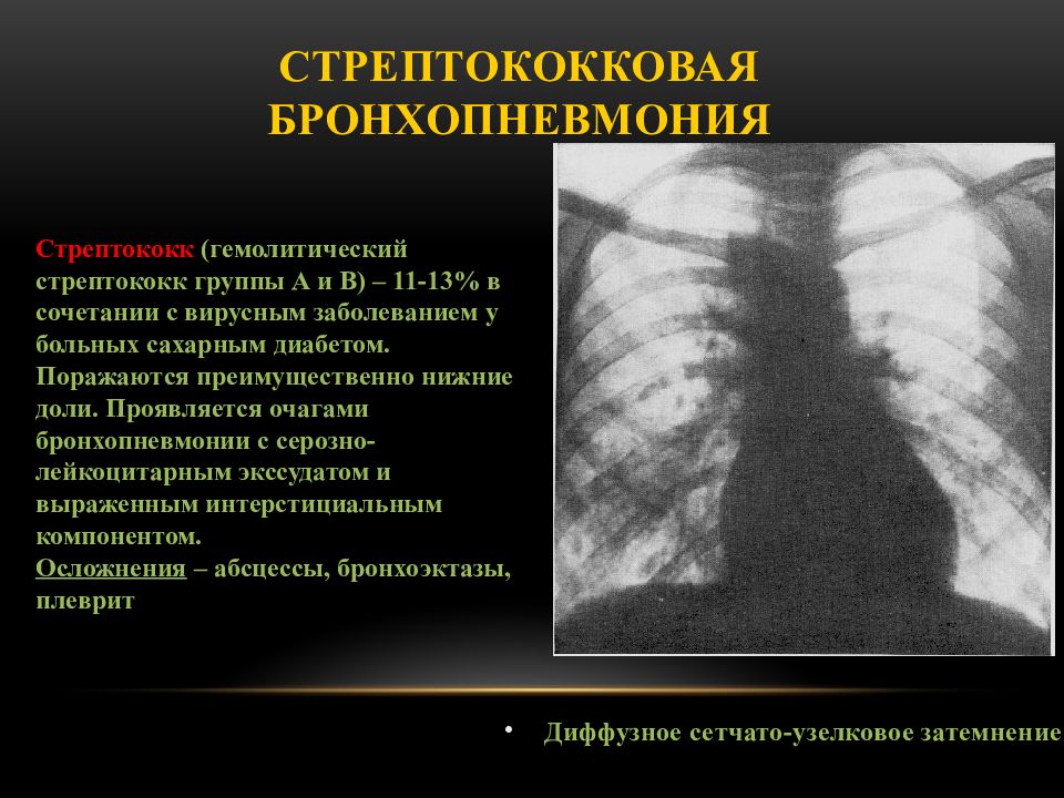 Бронхопневмония у детей. Стрептококковая пневмония рентген. Стрептококковая бронхопневмония. Бронхопневмония рентген. Бронхопневмония на рентгенограмме.