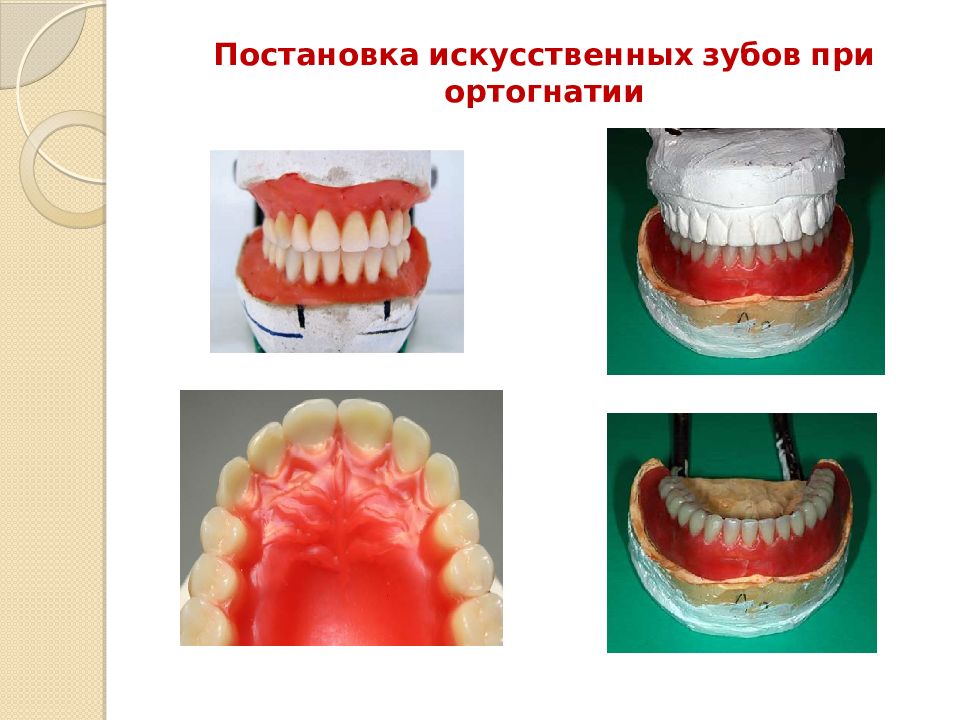 Постановка искусственных зубов по васильеву презентация