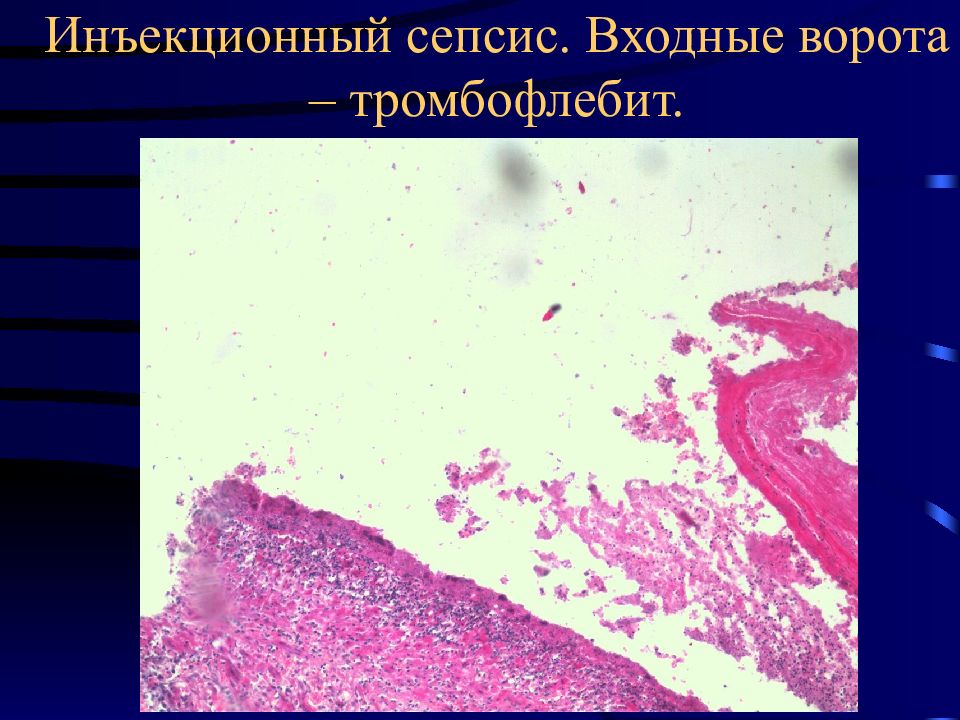 Патологическая анатомия презентации. Септический очаг это патанатомия. Сепсис патологическая анатомия. Септицемия патанатомия.