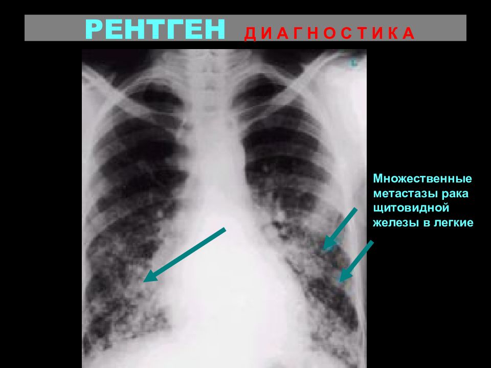 Рак молочной железы метастазы в легких. Рентген щитовидной железы. Метастазы опухоли щитовидной железы. Узел щитовидной железы на рентгене. Рентгенограмма щитовидной железы.