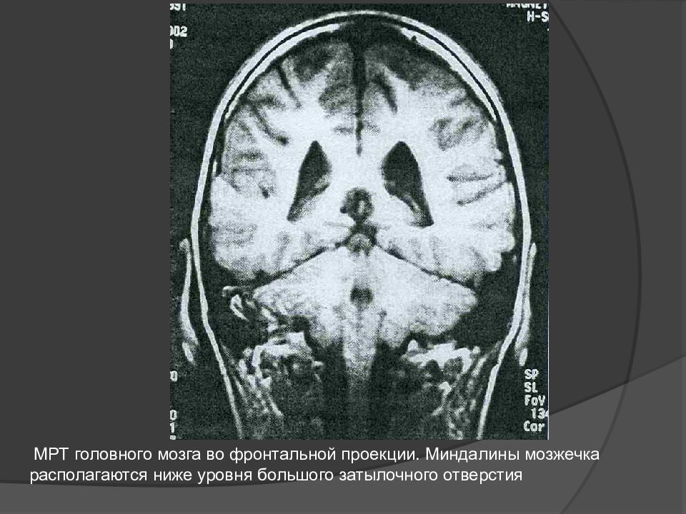 Спинномозговые грыжи презентация