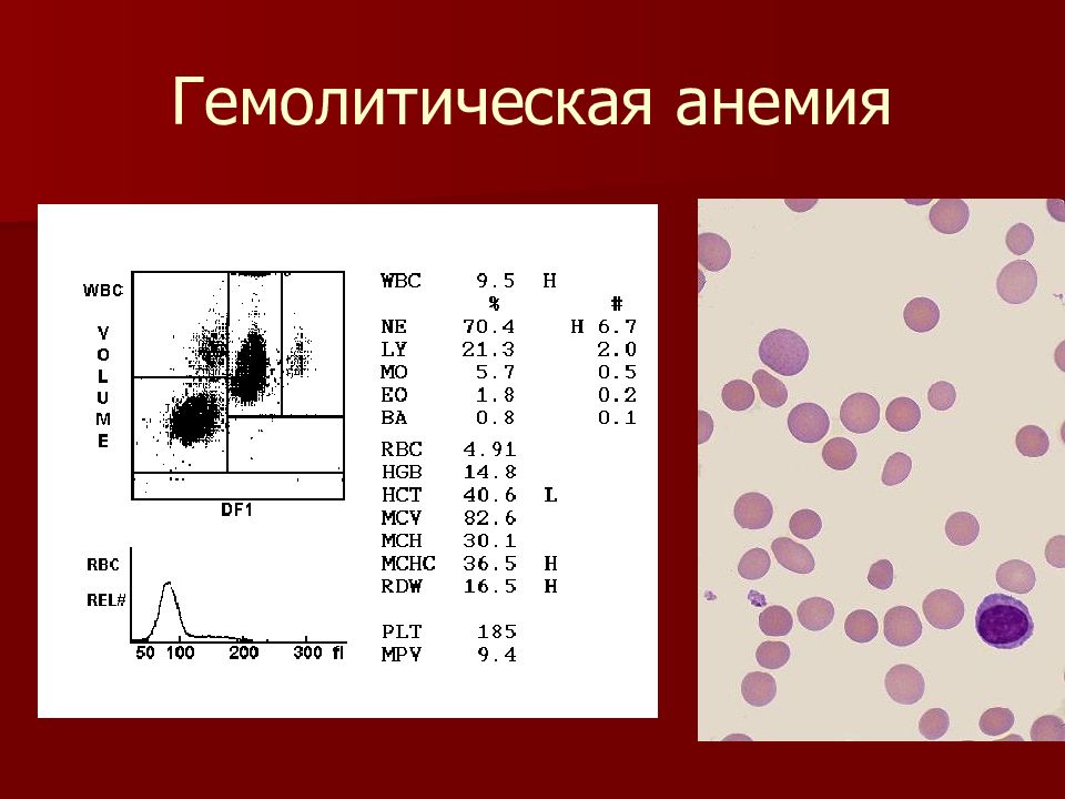 Картина крови при гемолитической анемии