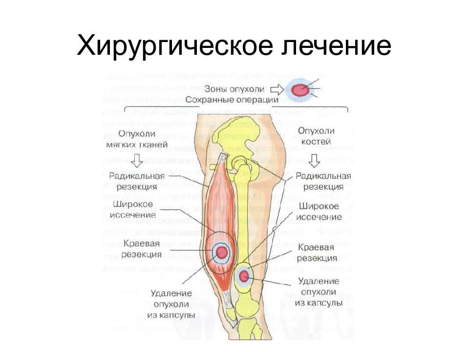 Опухоли костей схема