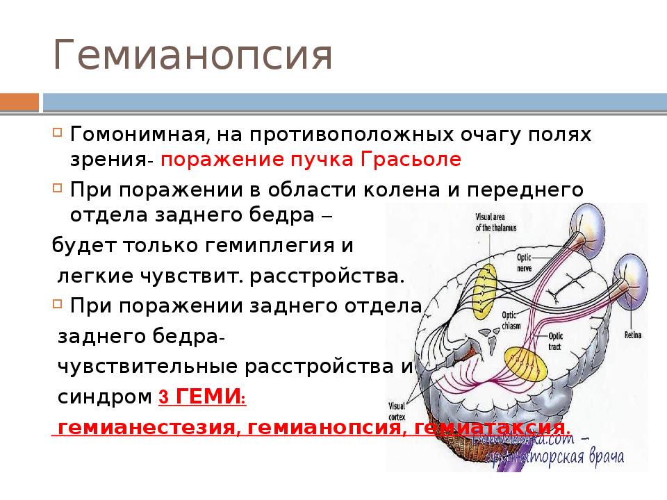 Внутреннее поражение. Правосторонняя гомонимная гемианопсия очаг поражения. Гомонимная гемианопсия при поражении внутренней капсулы. Симптомы поражения внутренней капсулы. Поражение зрительного бугра.