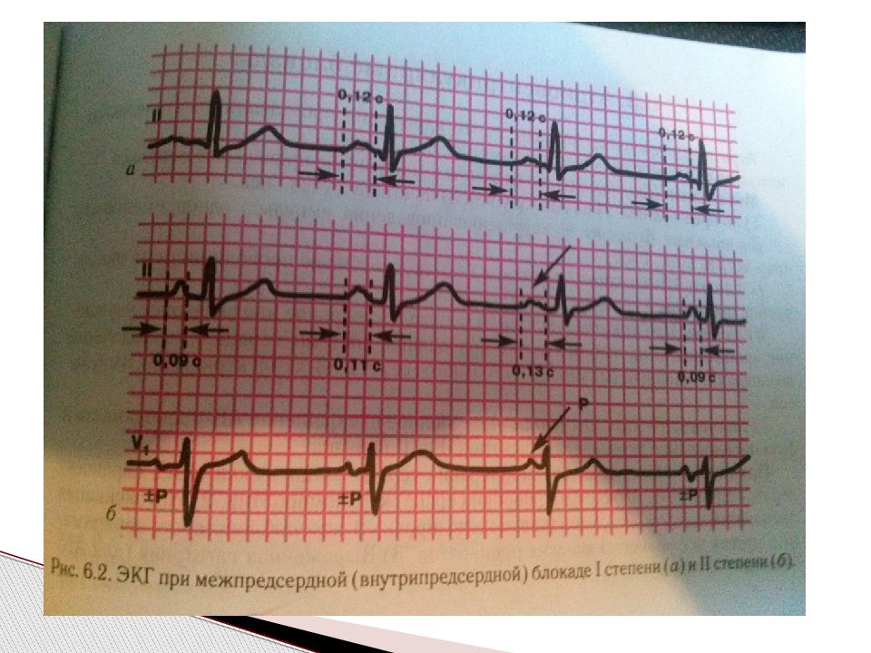 Внутрипредсердная проводимость. Внутрипредсердная блокада на ЭКГ. Межпредсердная блокада 2 степени ЭКГ. Внутрипредсердные блокады на ЭКГ. ЭКГ при внутрипредсердной блокаде.