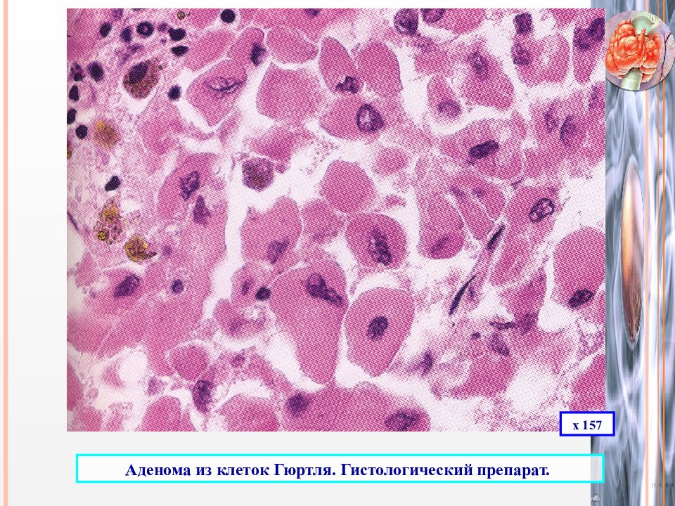 Щитовидный железа аденома. Гюртлеклеточная аденома щитовидной железы. Гюртлеклеточная аденома щитовидной железы цитология. Клетки Ашкенази в щитовидной железе гистология. Клетки Ашкенази-Гюртля.