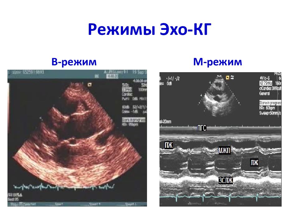 Эхокардиография сердца презентация