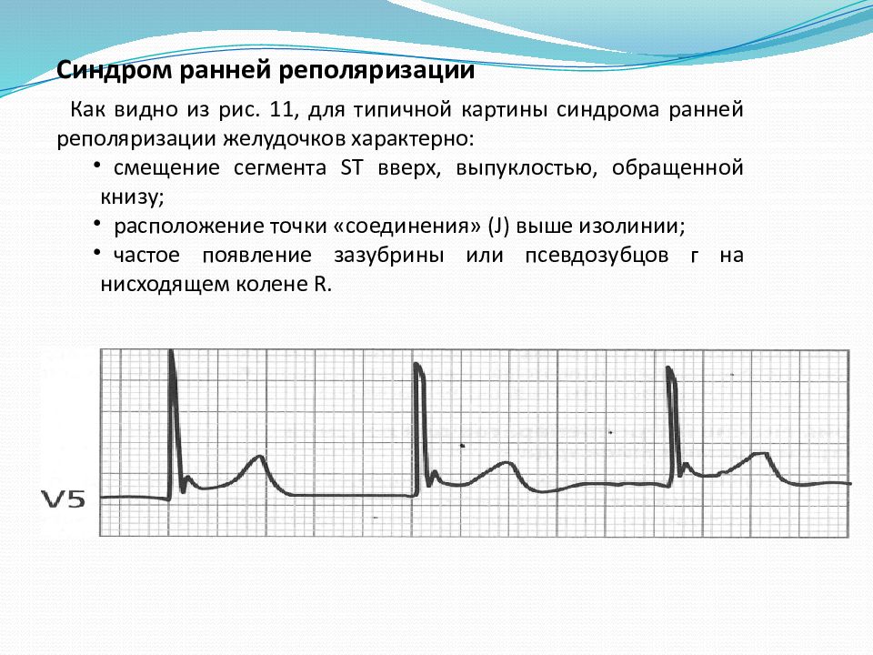 Реполяризация желудочков на экг. Синдром ранней реполяризации желудочков ЭКГ критерии. Феномен ранней реполяризации желудочков на ЭКГ. Синдром ранней реполяризации на ЭКГ. ЭКГ при синдроме ранней реполяризации.