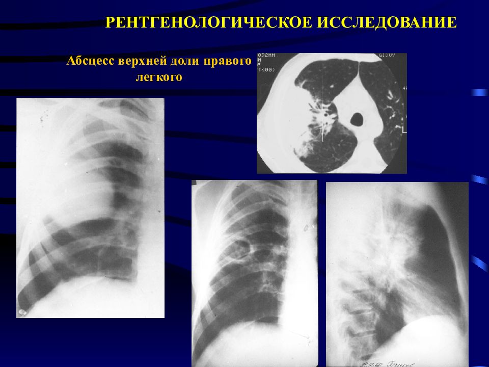 Уплотнение легочной ткани. Синдром легочного уплотнения на рентгене. Синдром уплотнения легочной ткани (крупозная и очаговая пневмонии. Синдром уплотнения легочной ткани рентген. Абсцесс легкого верхней доли правого легкого.