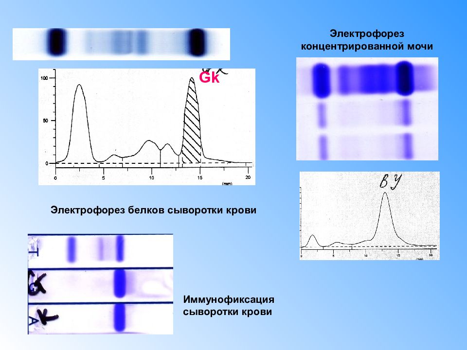 М градиент при миеломной. Иммунофиксация белков сыворотки крови. Миеломная болезнь электрофорез белков. Решетки Брэгга в оптоволокне.