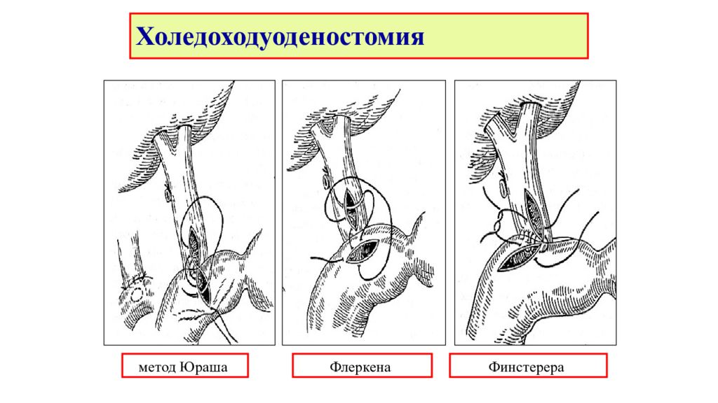 Способ б. Холедоходуоденальный анастомоз. Метод Финстерера холедоходуоденостомия. Холедоходуоденостомия по Юрашу. Холедохр дуоденальный анастомоз.