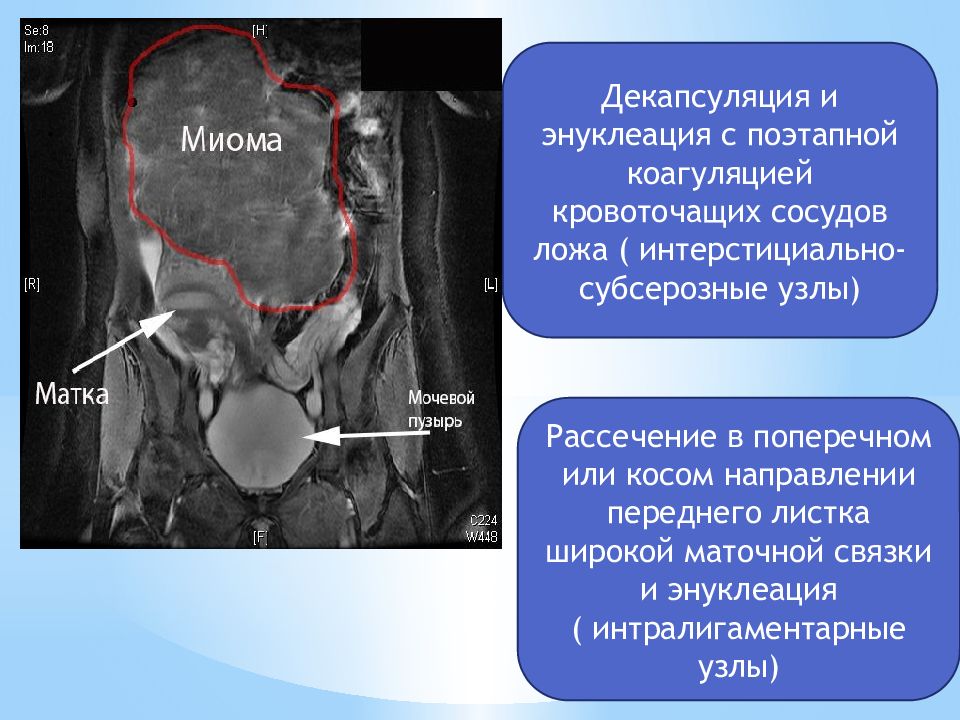 Презентация миома матки и беременность