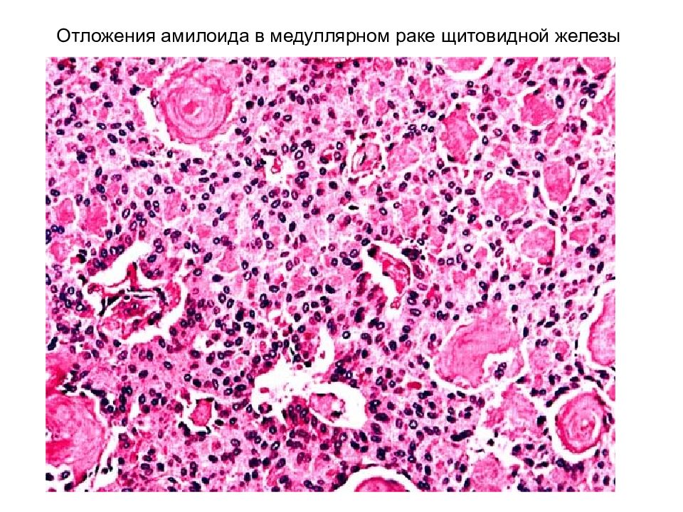 Медуллярный рак. Медуллярная карцинома щитовидной железы гистология. Амилоидоз щитовидной железы. Амилоидоз щитовидной железы макропрепарат.