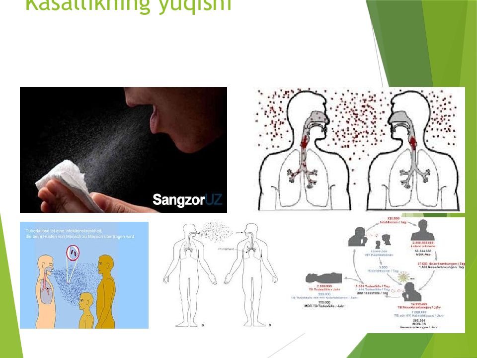 O'PKA OBSTRUKTIV YETISHMOVCHILIGI DIAGNOSTIKASI Kasallikning yuqishi