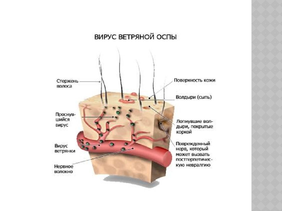 ветряная оспа строение вируса. ветряная оспа строение. вирус ветряной оспы патогенез. вирус ветряной оспы строение. ветряная оспа строение.