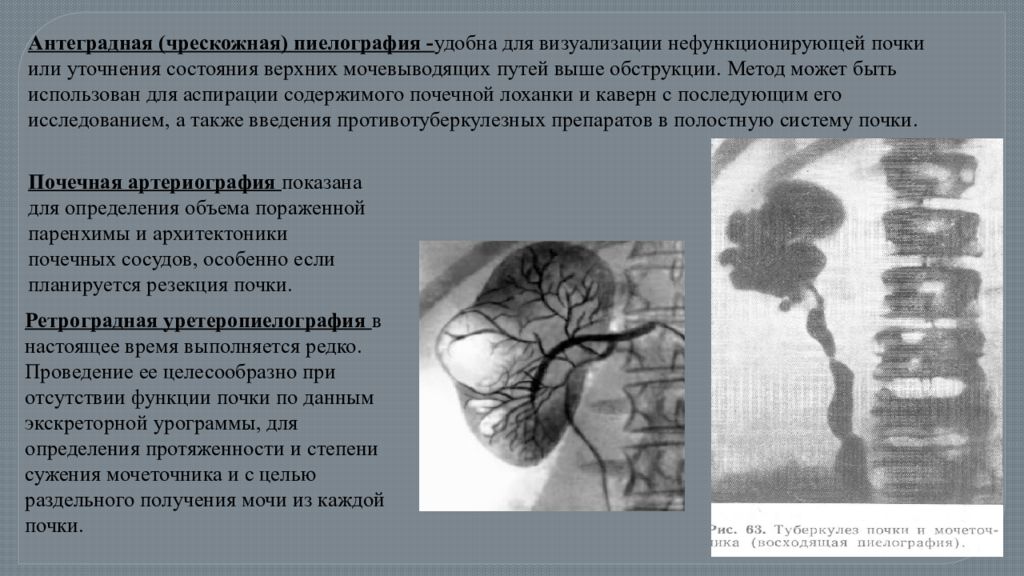 Туберкулез почек и мочевыводящих путей презентация