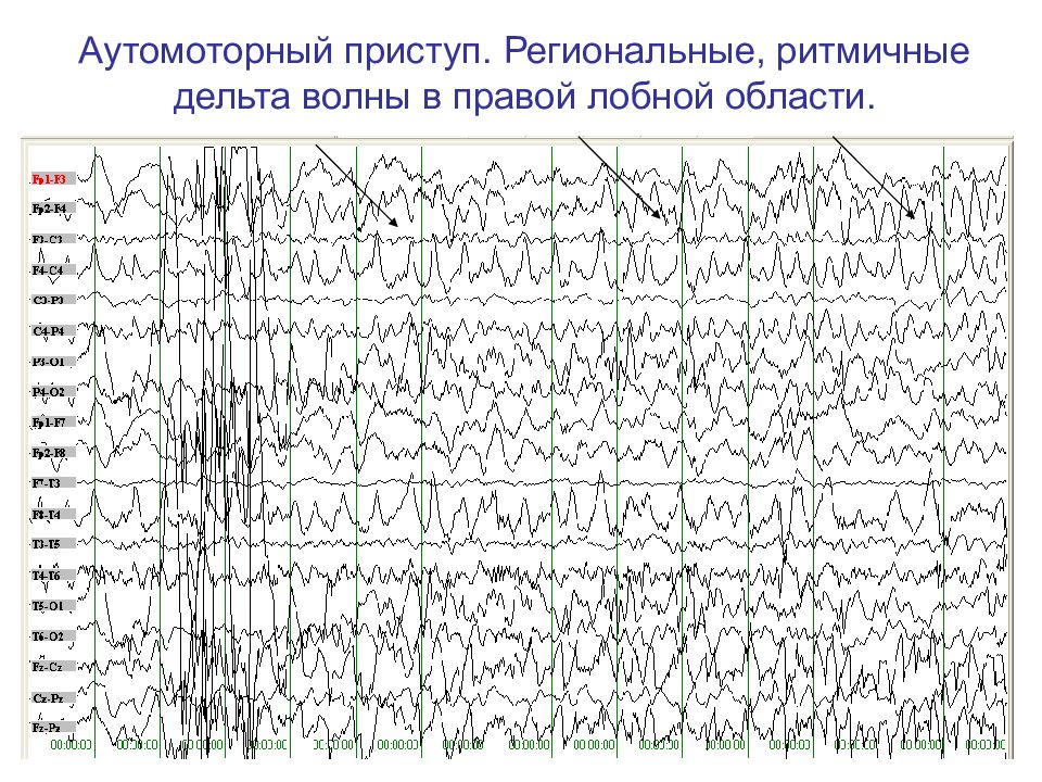 Ээг эпилепсия картинки