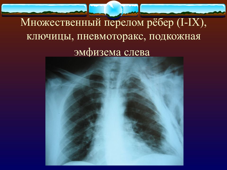 Подкожная эмфизема. Пневмоторакс подкожная эмфизема. Перелом ребер пневмоторакс рентгенограмма. Перелом ребер с подкожной эмфиземой. Пневмоторакс с подкожной эмфиземой рентген.