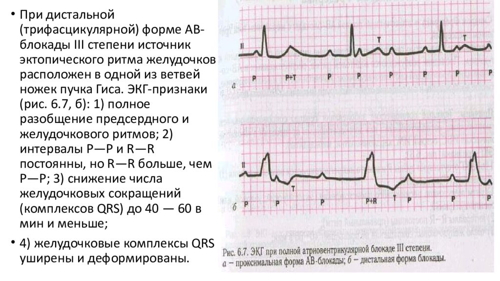 Полная ав блокада карта вызова скорой медицинской