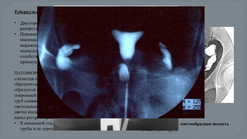 туберкулез маточных труб. туберкулез маточных труб гсг. гистеросальпингография туберкулез. туберкулез маточных труб. туберкулез маточных труб.