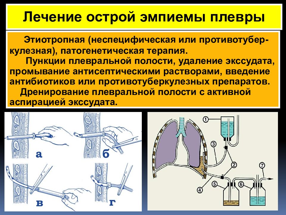 Острая эмпиема плевры презентация