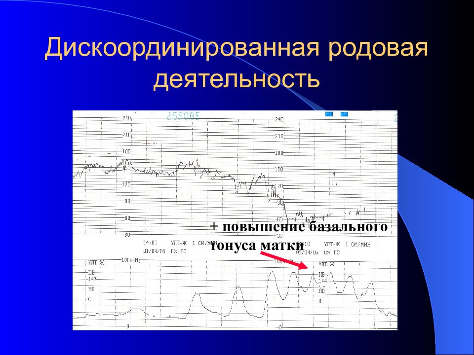 Аномалии родовой деятельности картинки