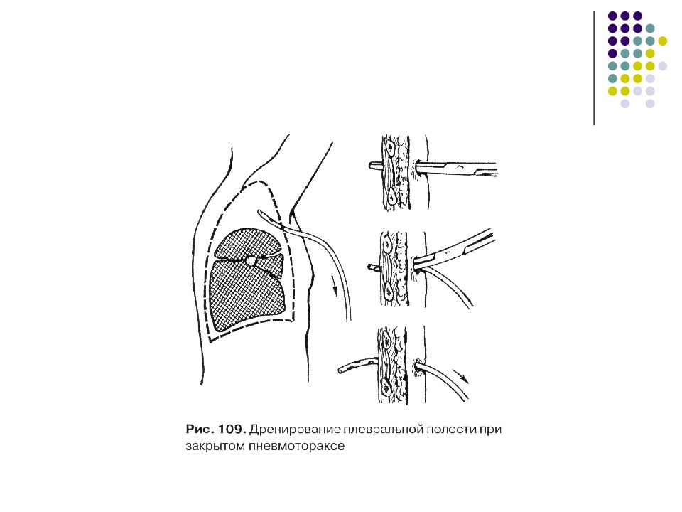 Способы дренирования плевральной полости презентация