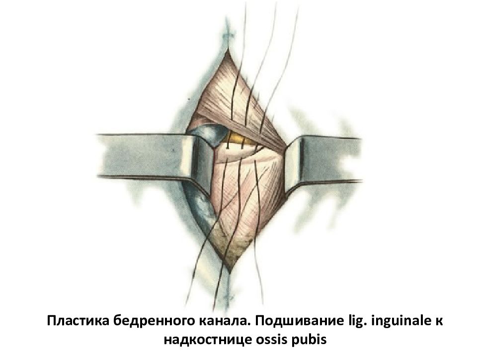 Бассини при бедренной грыже. Герниопластика бедренной грыжи. Способ Локвуда Бассини. Операция Бассини бедренная грыжа.